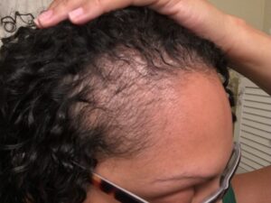Postpartum Hairloss: 5 ways to treat postpartum shedding