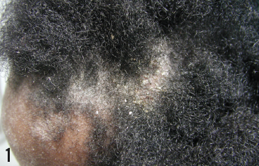The Real Cause of Dandruff: symptoms, causes, 7 tips to get rid of it |  Oleena Organics